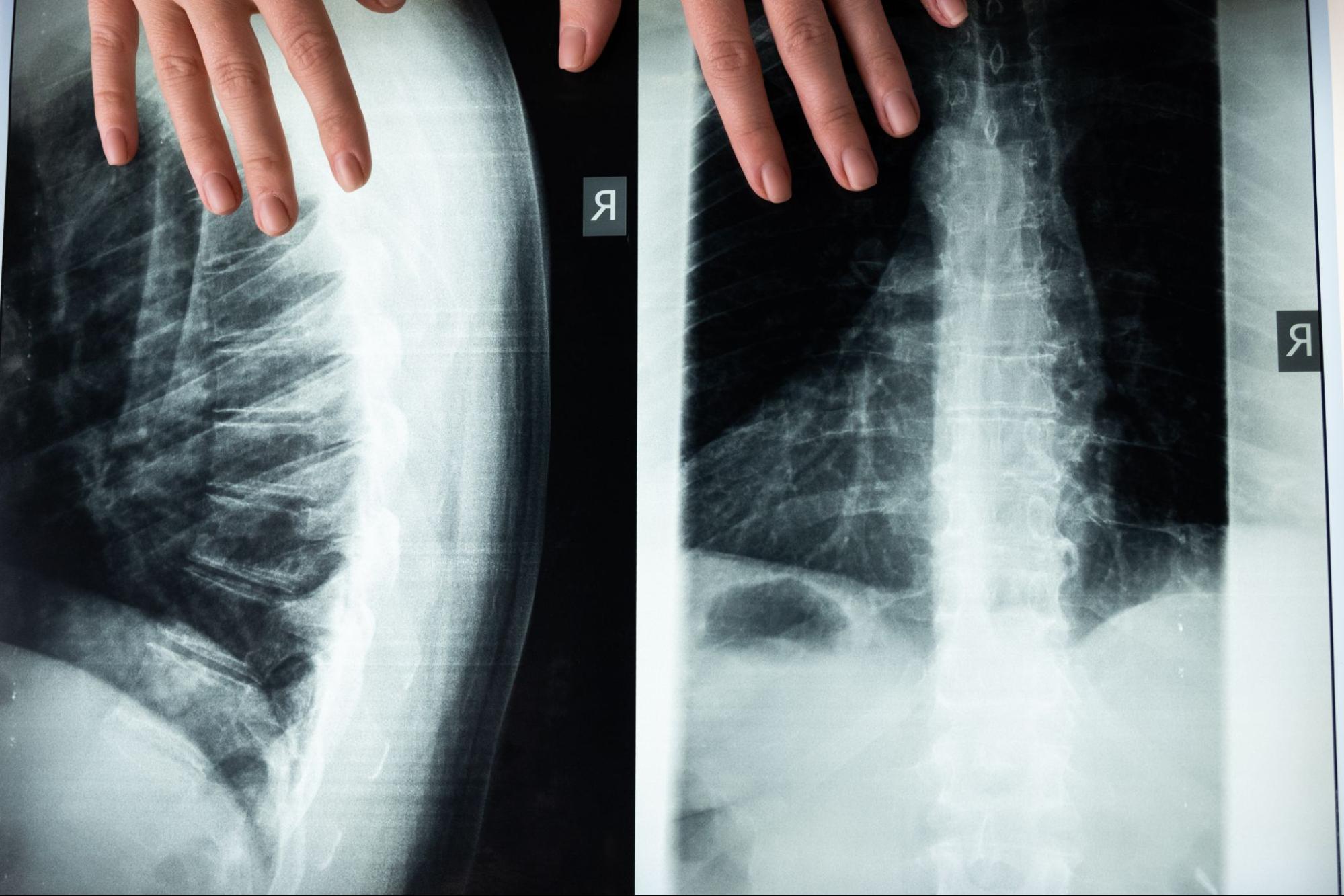 radiographie lombaire