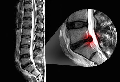 scan for sciatica