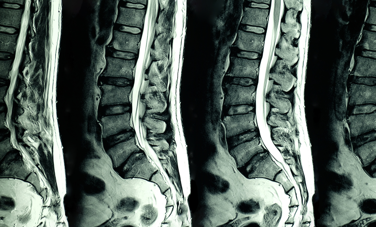 medical imaging showing a herniated disc