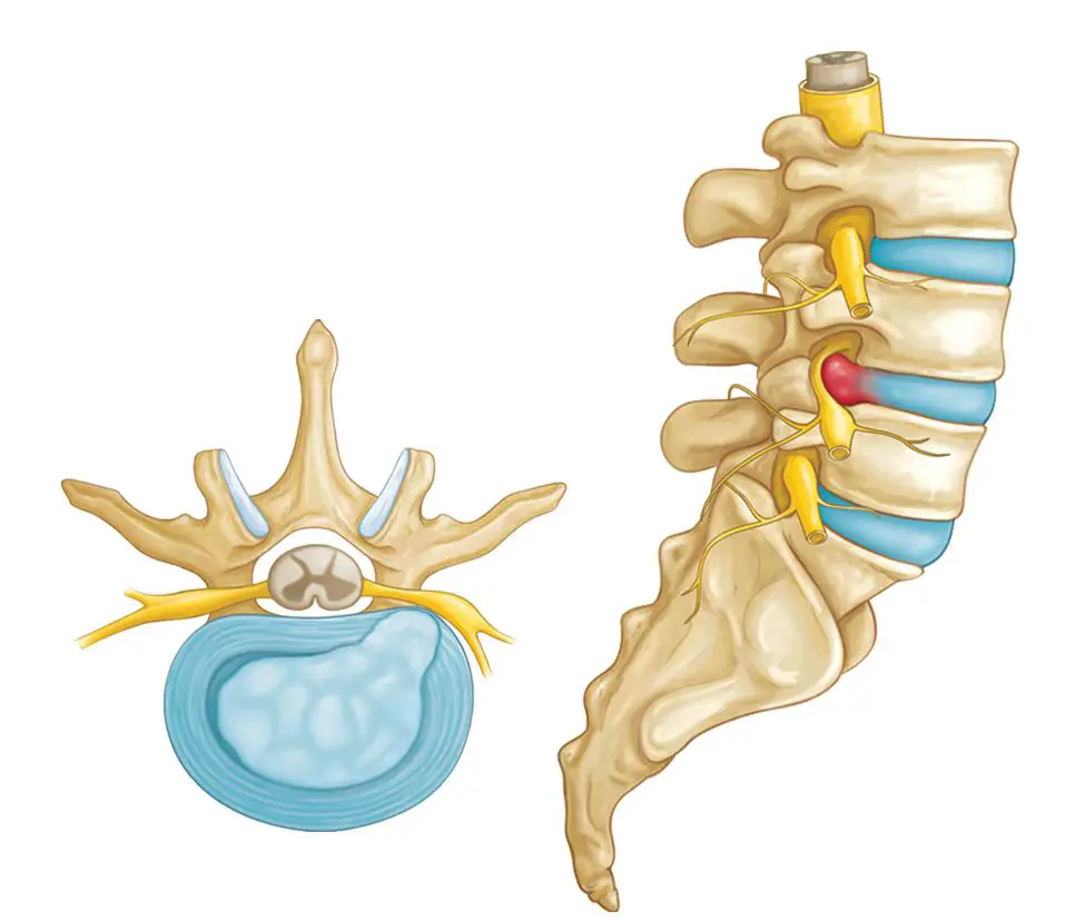 schema qui montre une profusion discale relié au mal de dos et qui peut être traitée par la méthode Mckenzie