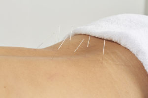 acupuncture utilisée suite à une sténose spinale