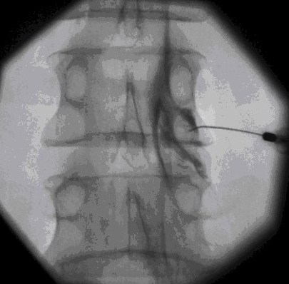 epidurale Infiltration