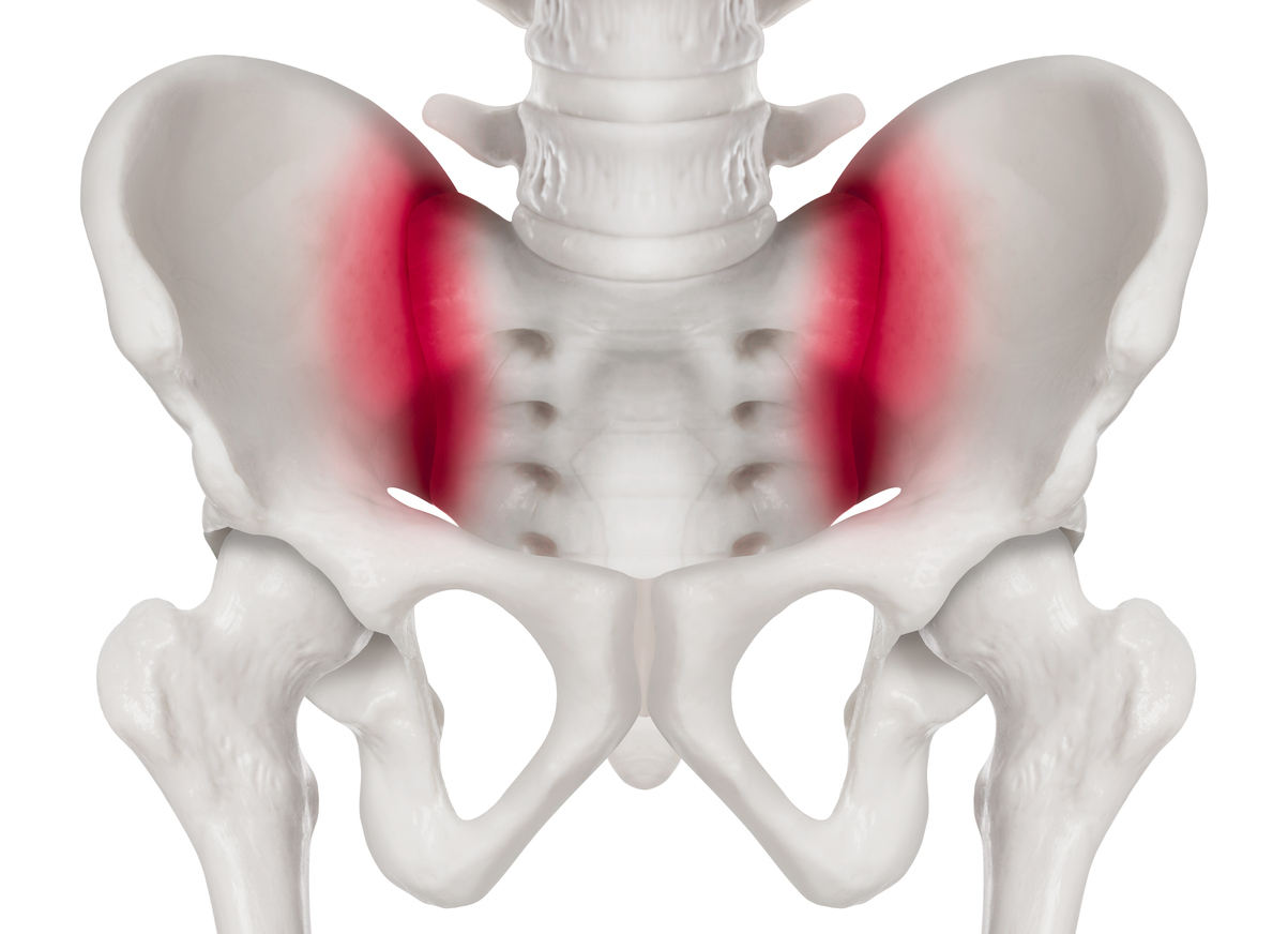 Sakroilitis, die auf eine entzündliche Beteiligung hinweist, die bei entzündlichen Rückenschmerzen vorhanden ist