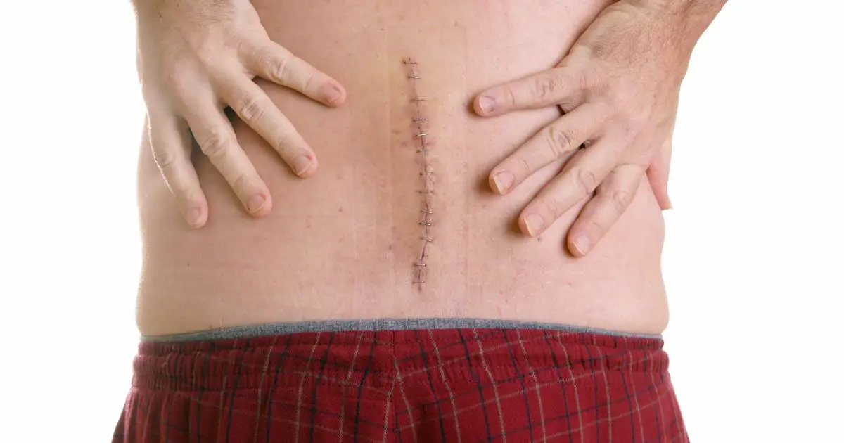 cicatrice après une opération du dos