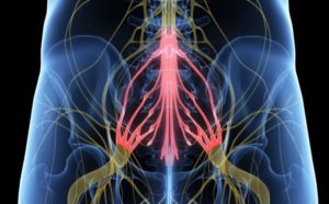 síndrome de la cauda equina a causa del canal espinal estret
