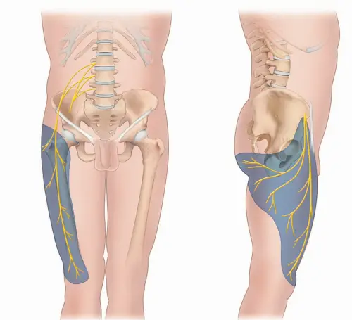 Meralgia Parthetica, eine Differenzialdiagnose der Kruralgie