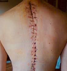 scoliosis scar