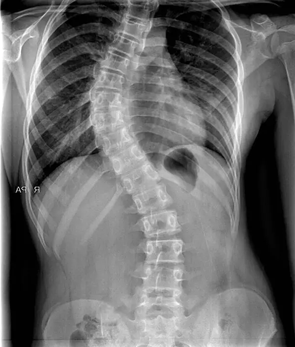 рентгенова снимка на сколиоза