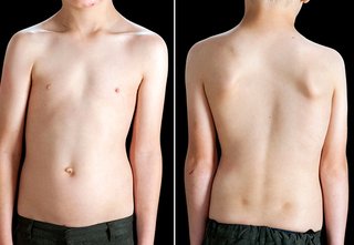 scoliosis in children