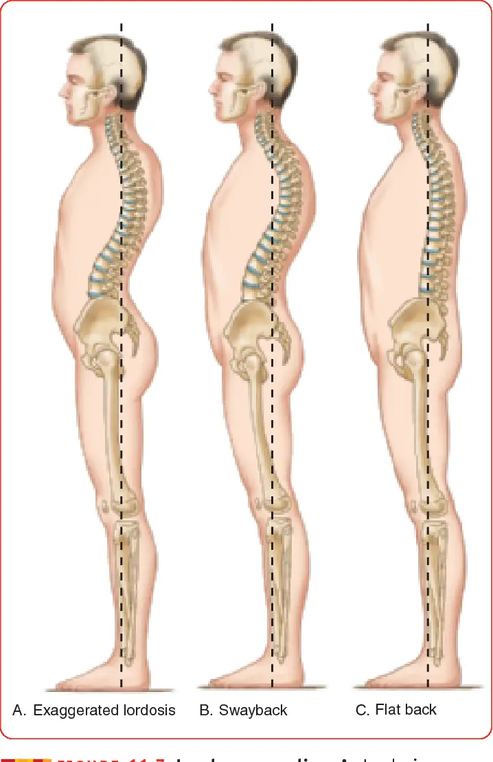 disminució de la lordosi lumbar observada