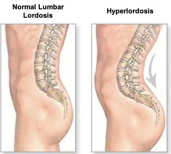 Hiperlordosi lumbar causada per la retracció del psoas