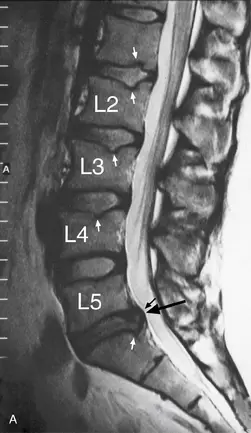 дискова протрузия, диагностицирана чрез медицинска образна диагностика (MRI)