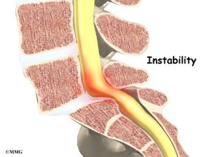 lumbal ustabilitet