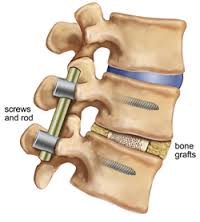 Lumbal artrodese efter spinal stenose