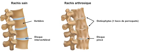 lumbal artrose 2 lumbal artrose og fatigue
