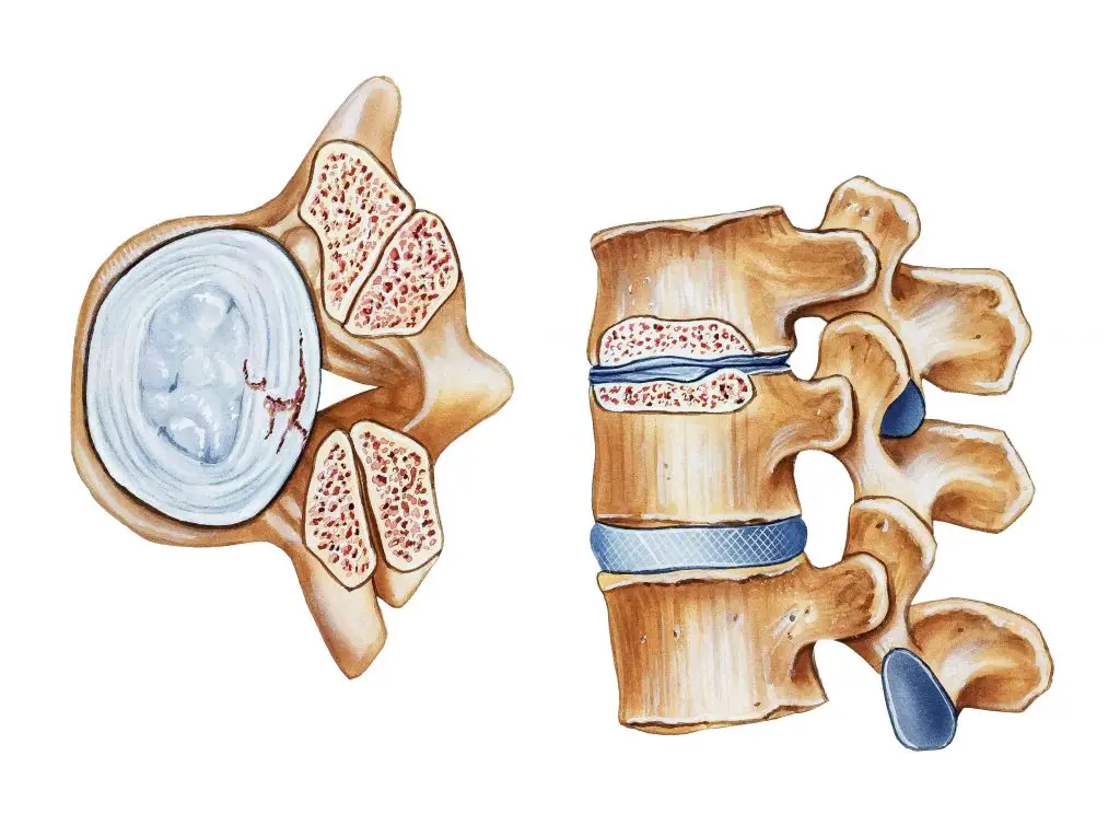 narrow lumbar canal