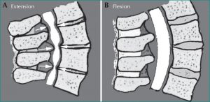 lumbal fleksion vs ekstension på spinal stenose