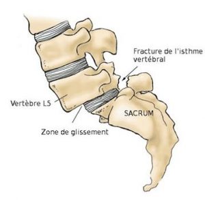 fratura do istmo vertebral levando a espondilolistese