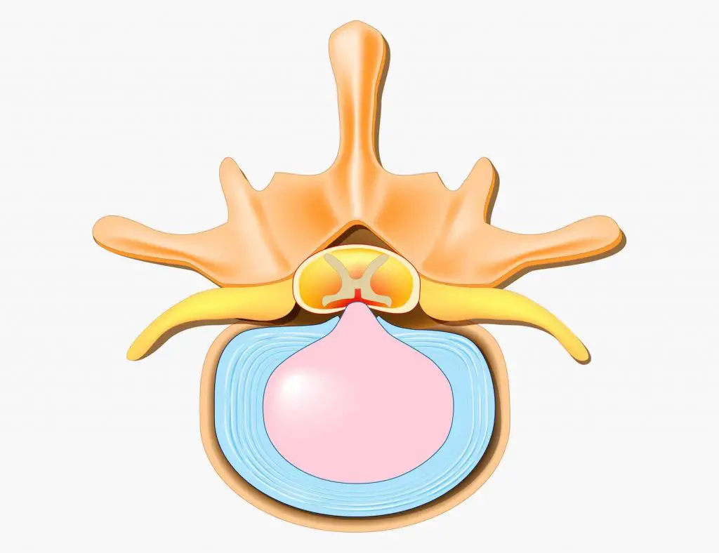 центральная грыжа диска