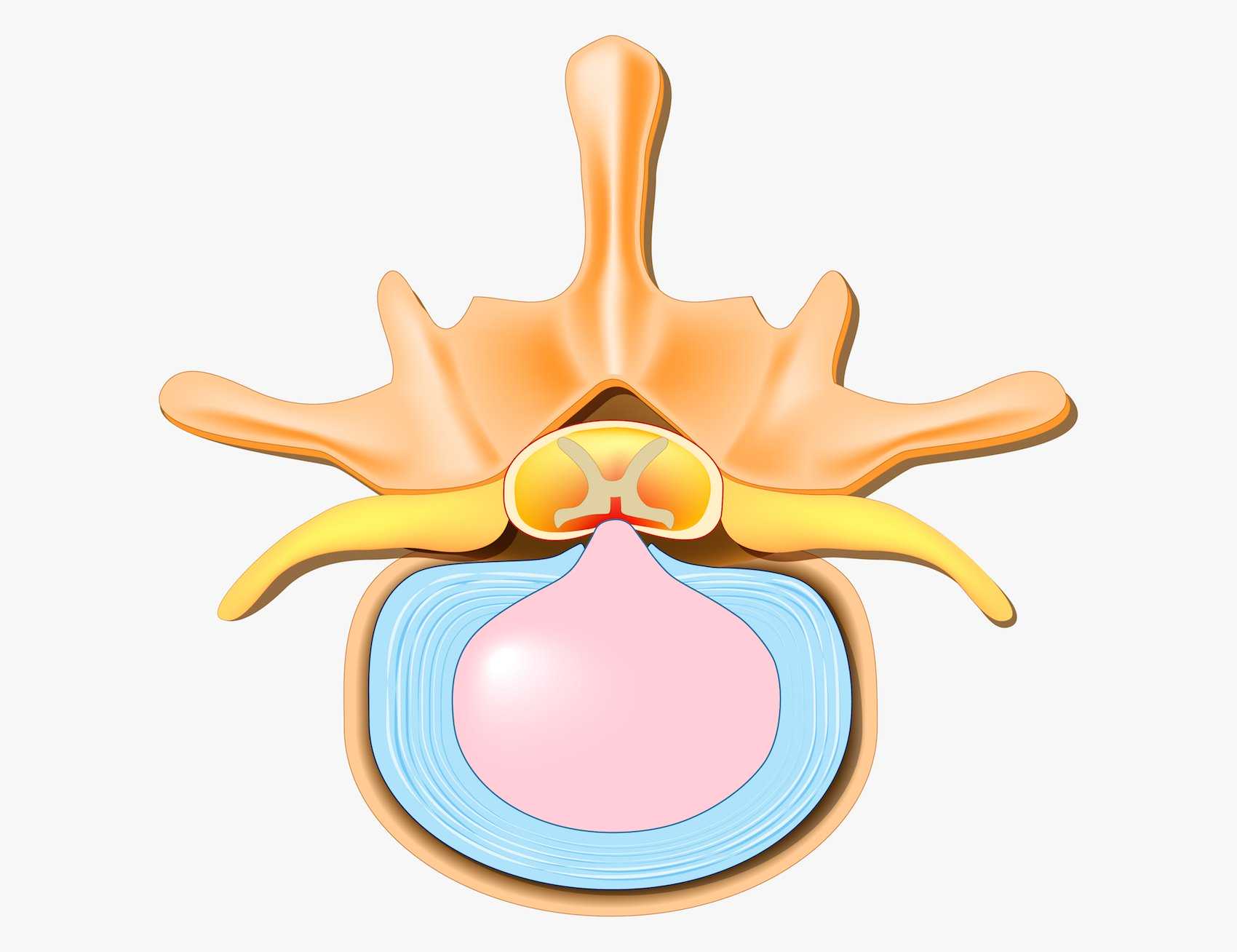 central disc herniation