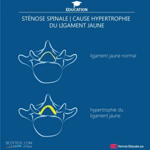 hypertrofi af det gule ledbånd, der forårsager spinal stenose
