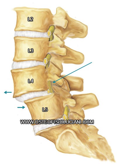spondilolistesis l4-l5