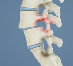 spondylolisthésis responsable de la sténose spinale