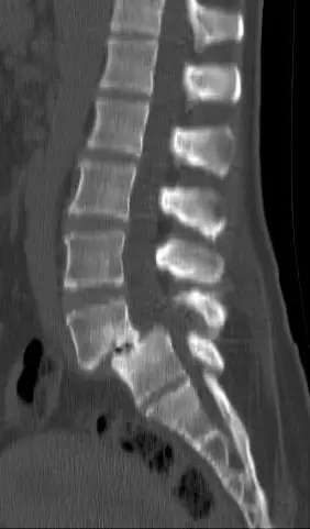 x-ray of spondylolisthesis