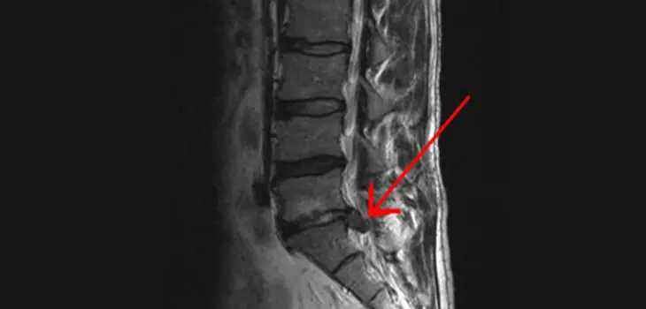 degenerativ diskussygdom diagnosticeret ved MR