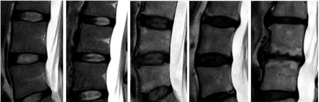 degenerative Bandscheibenerkrankungen