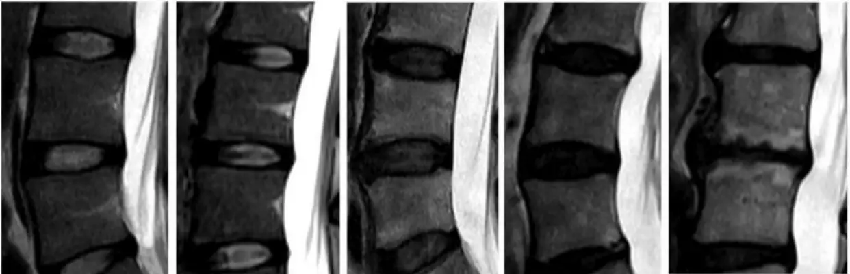 degenerative disc disease