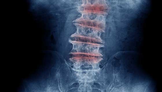椎間板変性疾患を特定するための医用画像