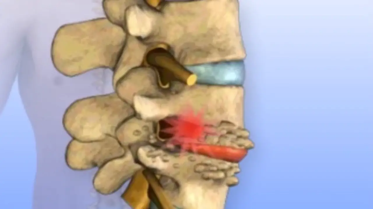 degenerative disc disease at the L4-L5 level