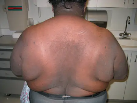acanthosis nigricans