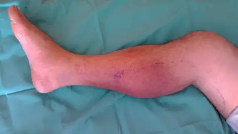phlebitis le uallach airson pian laogh