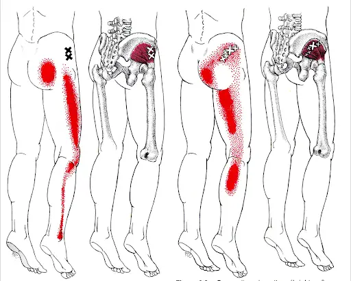 point gachette reponsables de la douleur derrière la cuisse
