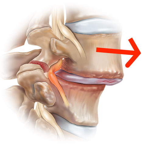 Spondylolisthese reizt den Nerv