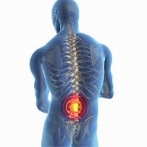 cauda equina syndrom