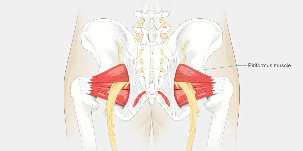 syndrome piriformis ag adhbhrachadh pian laogh