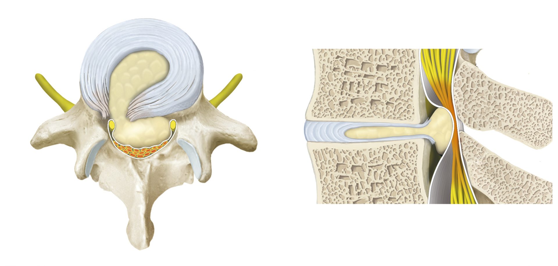 herniated disc compressing the ponytail