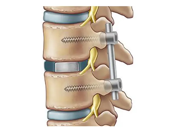 ledvena artrodeza