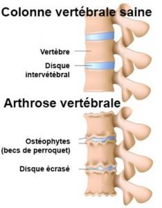 Arthrose der Wirbelsäule. Buckliger Rücken bei älteren Menschen