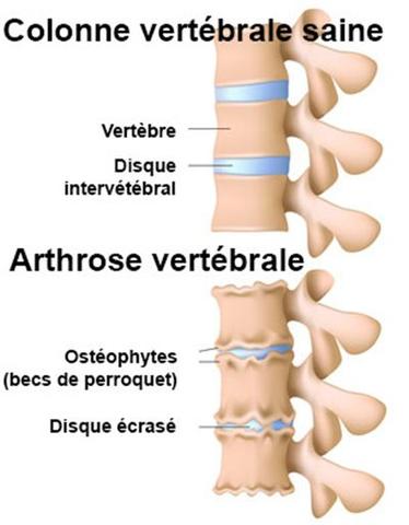 cervikal spondylose, der forårsager cervico-brachial neuralgi