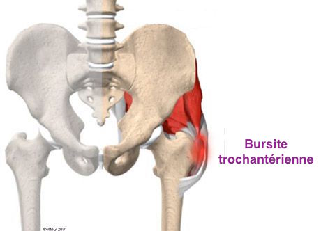 trochanterisk bursitis
