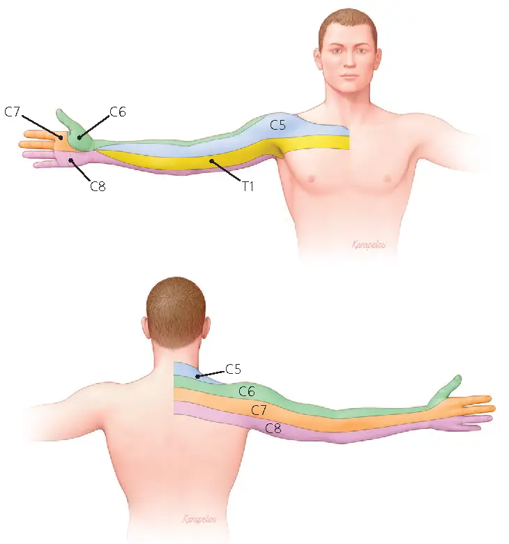dermatomer, der forklarer symptomerne på cervico-brachial neuralgi