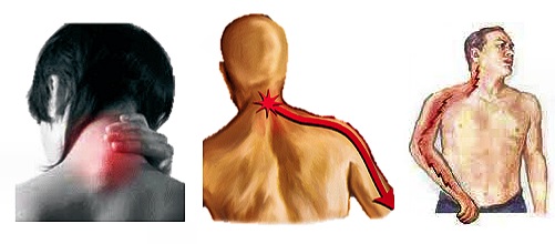 irradiations caused by cervico-brachial neuralgia