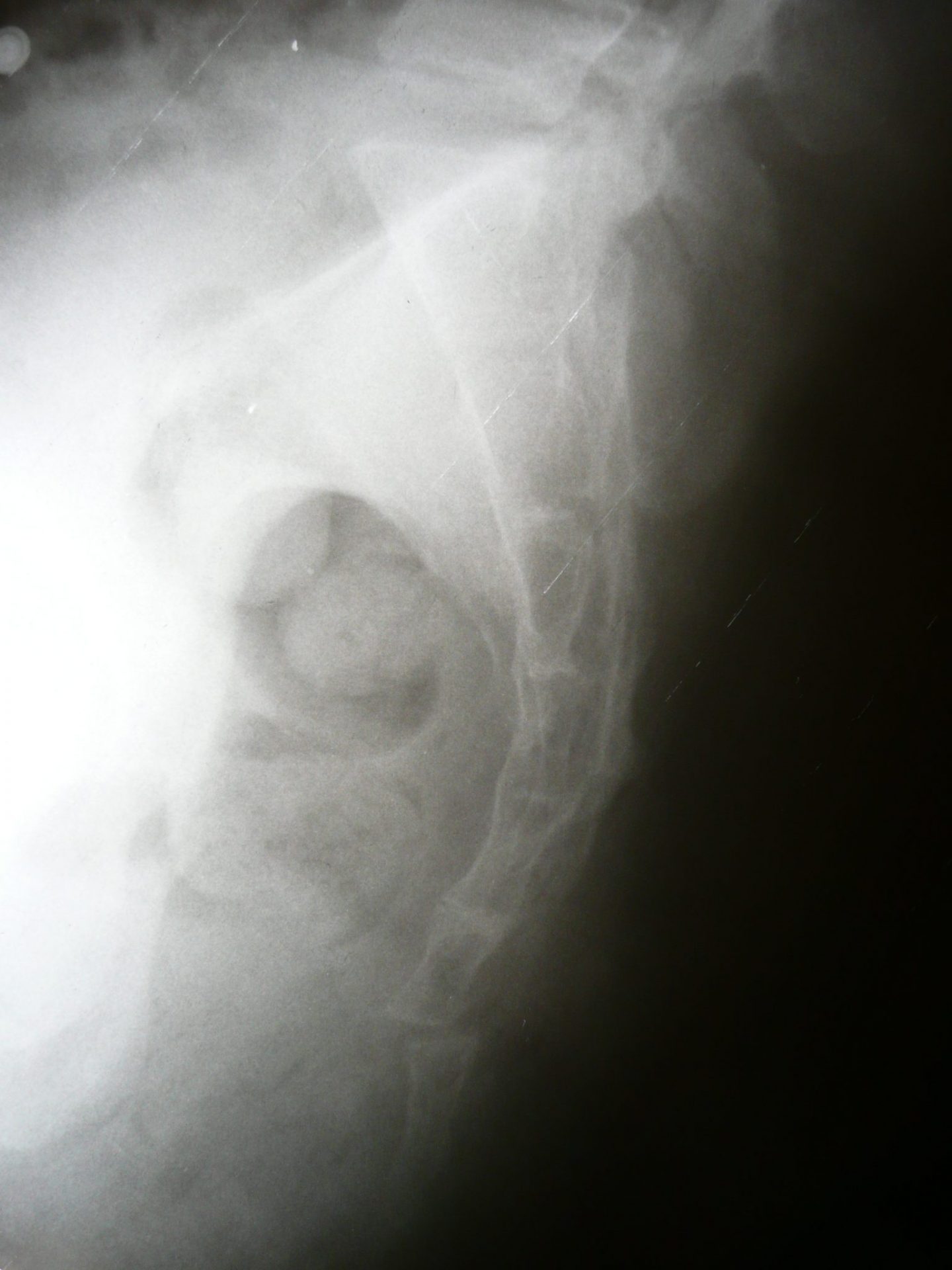 fractura del còccix responsable del dolor del còccix