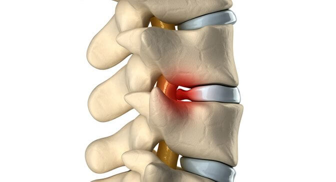 cervikálna hernia spôsobujúca cerviko-brachiálnu neuralgiu