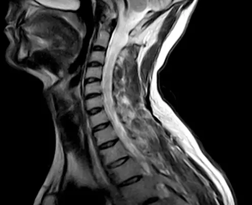 التصوير بالرنين المغناطيسي (MRI) لتوضيح تشخيص ألم العصب العنقي العضدي