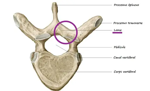lâmina vertebral removida em laminectomia lombar